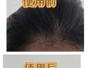 女人头发掉的厉害怎么办？有效预防和解决方法是什么？