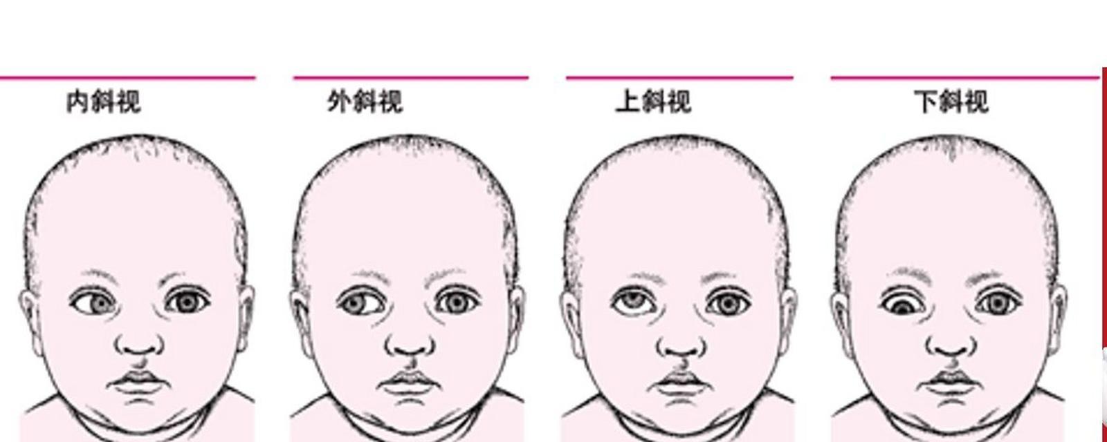 后天斜视的成因是什么？如何预防和治疗？  第2张