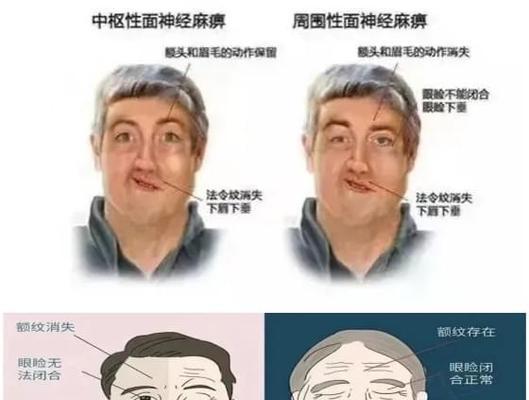 面瘫是什么引起的？有哪些可能的原因？  第2张